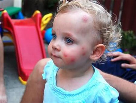 被蚊子咬了皮炎,蚊子咬引起了皮炎怎么治