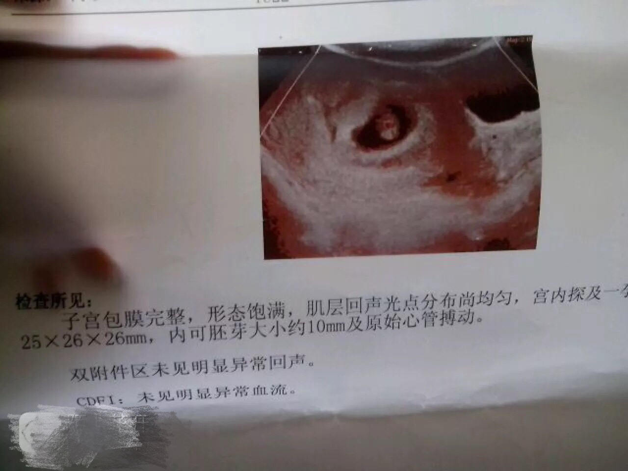 备孕常见问题解答：孕早期B超看不到孕囊怎么办？什么时候第一次B超最为合适？