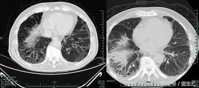 咳嗽胸闷反复发作久治不愈怎么办,反复咳嗽咳痰气促是什么病