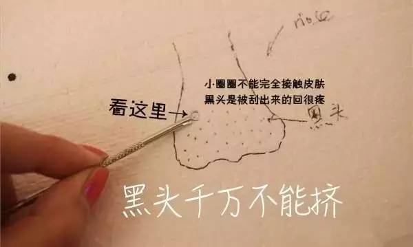 “黑头”这个渣男,彻底和他Say byebye~