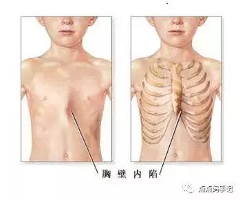 宝宝肋骨外翻怎么回事呀,宝宝肋骨外翻挂哪个科