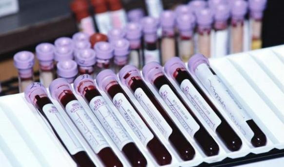 怀疑贫血看哪些指标,贫血了会第一时间发现贫血吗