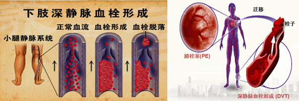 静脉血栓栓塞预防和治疗专家共识,静脉血栓防治的题目