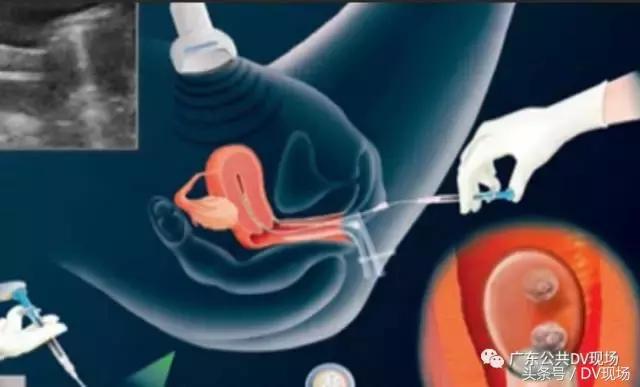 悲剧！广州妙龄女子为赚1.5万卖卵，不幸肚子变大