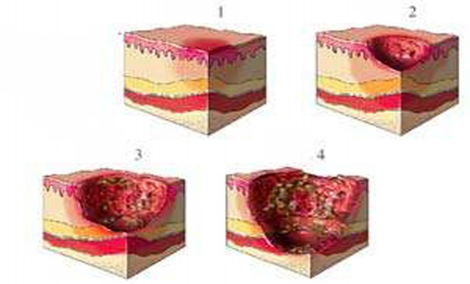发红、水泡、溃疡……不同阶段的褥疮该接受怎样的治疗？