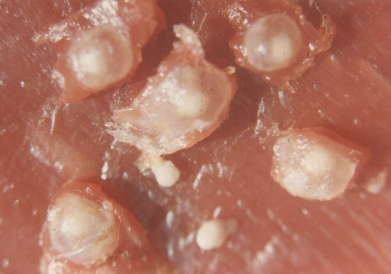 人感染猪囊虫病怎么办,人畜共患寄生虫病中的动物是什么