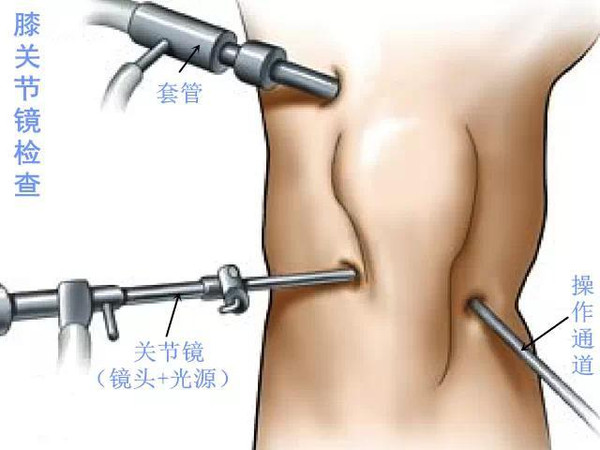 半夜半月板损伤膝盖有积液,膝盖半月板损伤要怎么治