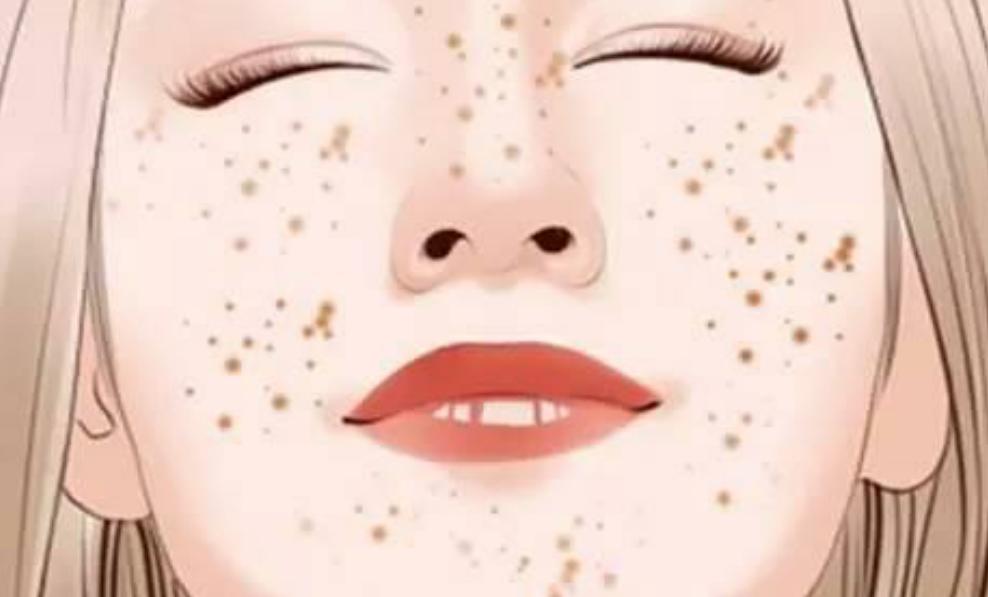 男士雀斑去除方法,脸上有雀斑怎么去除最快方法