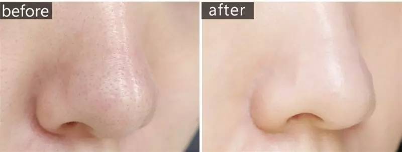 “黑头”这个渣男,彻底和他Say byebye~