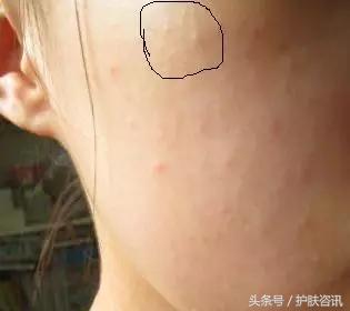 如何去除最顽固的闭口粉刺？