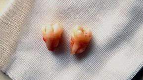 拔完智齿不缝针好吗,拔完智齿能喝冰红茶吗