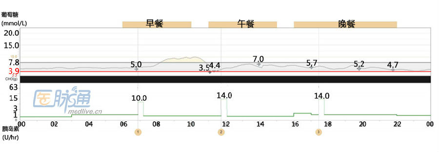 济南泉信｜怎样利用动态血糖监测仪调节胰岛素泵剂量？