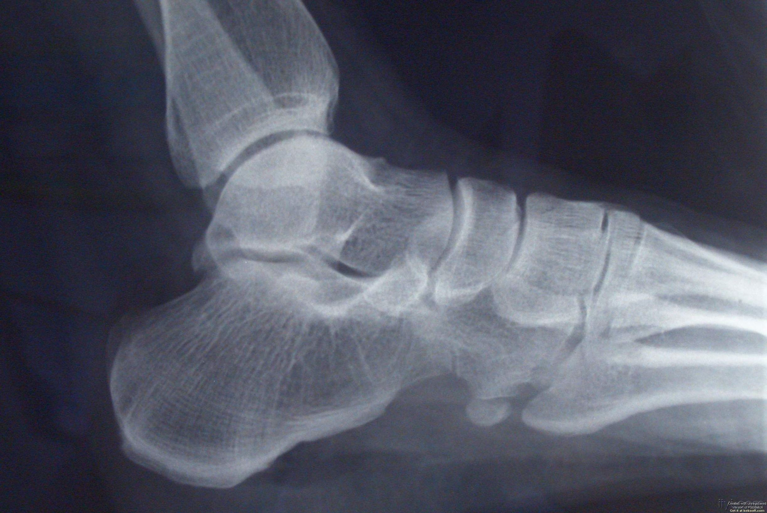 防止足跟长骨刺的鞋,脚后跟有骨刺要购买什么鞋