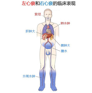 熟睡中因憋气而惊醒、呼吸困难,这些都是心力衰竭的症状,它发病率高,病残、病逝几率也高