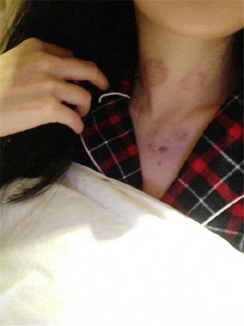 杨幂脖子前后对比,杨幂吻痕