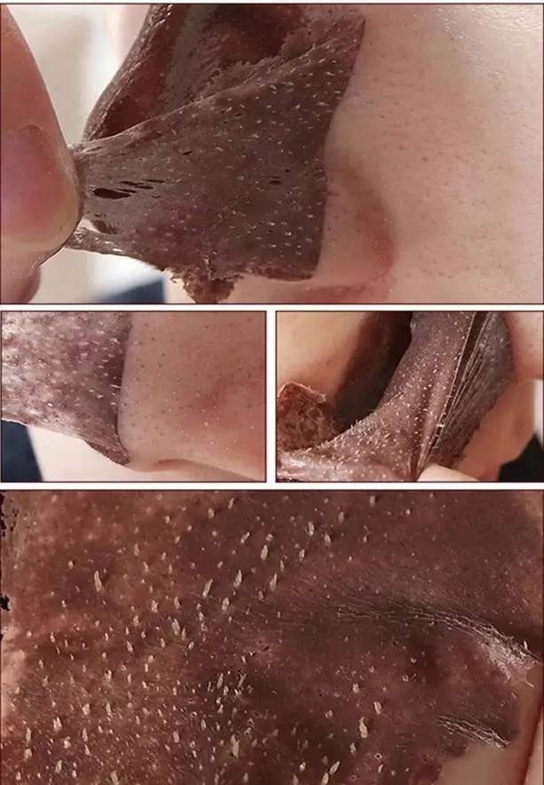 “黑头”这个渣男,彻底和他Say byebye~