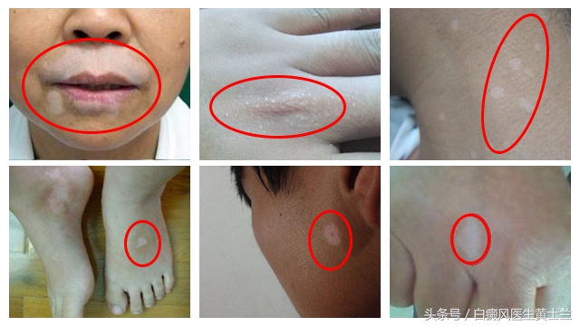 喝茶可以淡化黄褐斑吗,喝茶能治疗白癜风吗