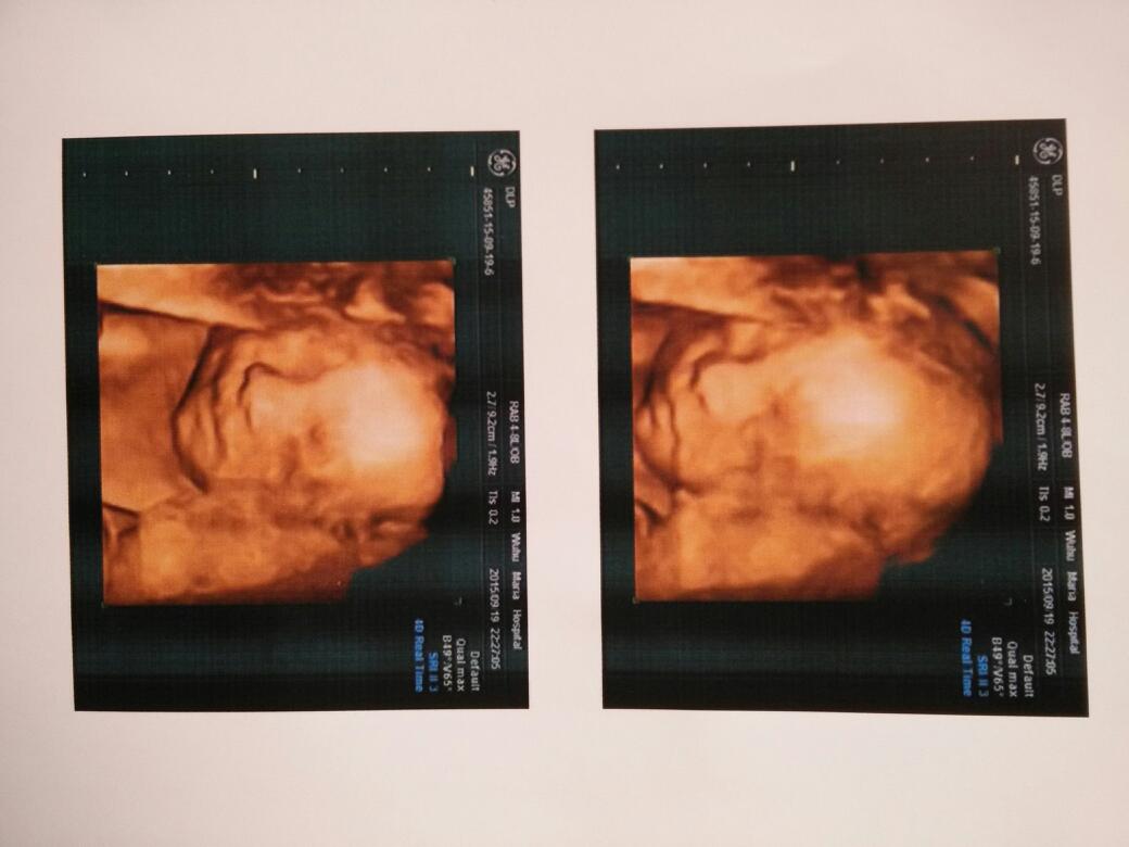 孕妇32周以后胎盘还能长上去吗,孕33周胎盘成熟2级了