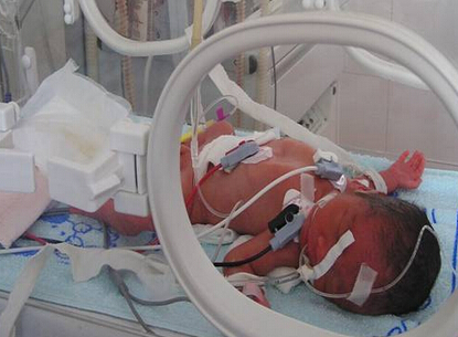 喜得爱子要随多少钱,早产儿花100万报销多少