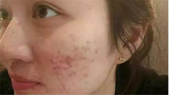 脸上有痘可以用芦荟胶吗 (完美芦荟胶可以去除脸上的痘吗)