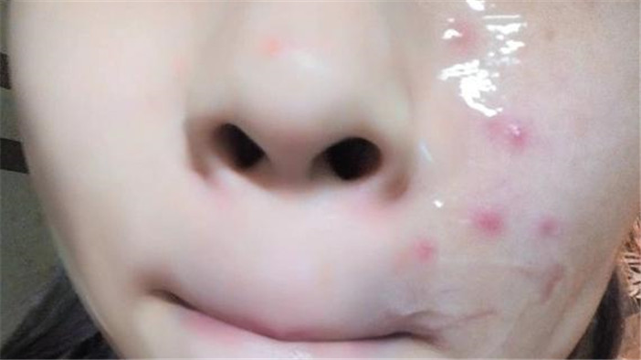 脸上有痘可以用芦荟胶吗 (完美芦荟胶可以去除脸上的痘吗)