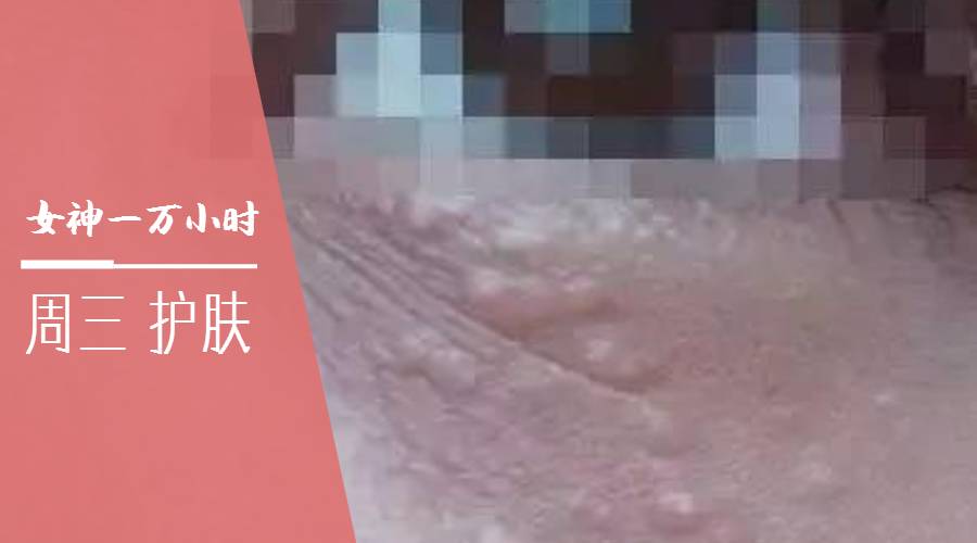 痘痘一直治不好的根本原因,痘痘是痤疮还是毛囊炎怎么判断