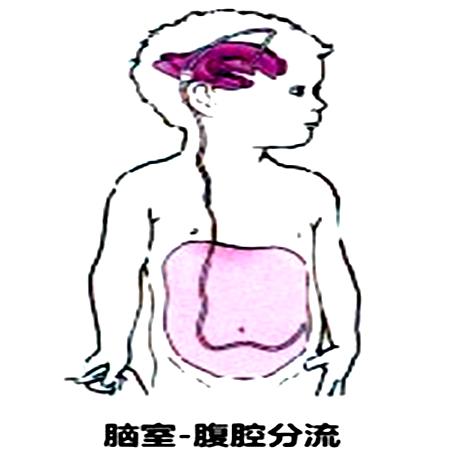 儿童脑积水的症状和治疗,儿童脑积水最佳治疗方案