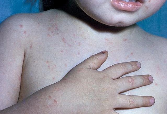 小孩螨虫叮咬最快消除方法,宝宝身上螨虫红疹子怎么治