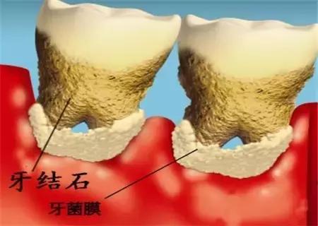 怎么判定自己有牙结石,牙结石跟牙结石有什么区别