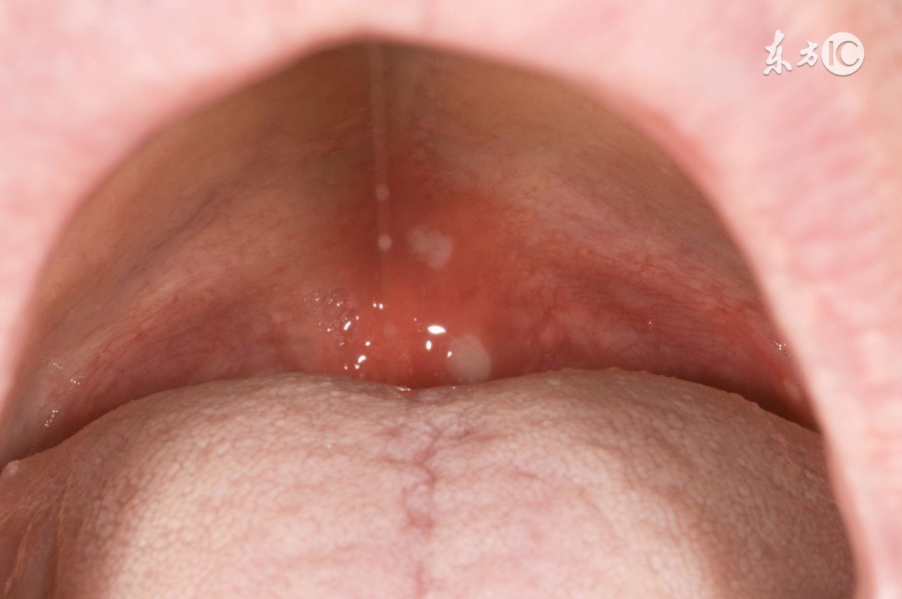 鹅口疮的快速治疗方法新生儿,新生儿鹅口疮不治疗会自愈吗