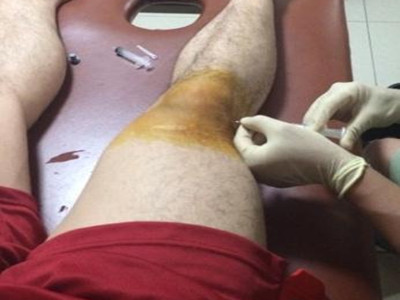 半夜半月板损伤膝盖有积液,膝盖半月板损伤要怎么治