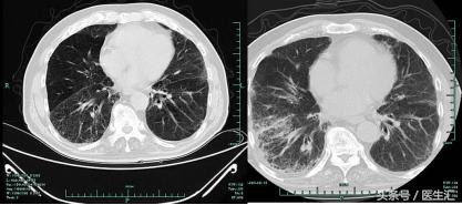 咳嗽胸闷反复发作久治不愈怎么办,反复咳嗽咳痰气促是什么病