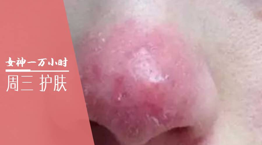 痘痘一直治不好的根本原因,痘痘是痤疮还是毛囊炎怎么判断