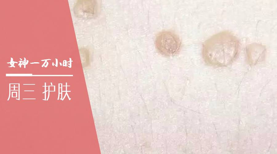 痘痘一直治不好的根本原因,痘痘是痤疮还是毛囊炎怎么判断