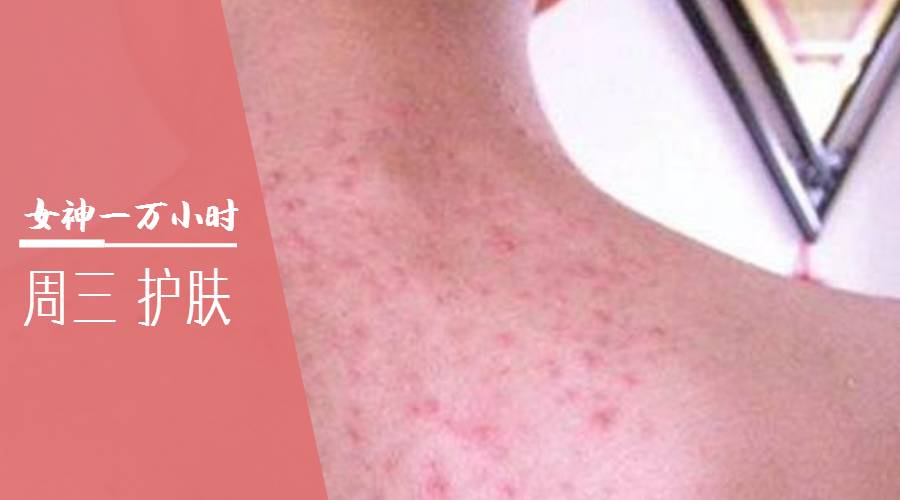 痘痘一直治不好的根本原因,痘痘是痤疮还是毛囊炎怎么判断