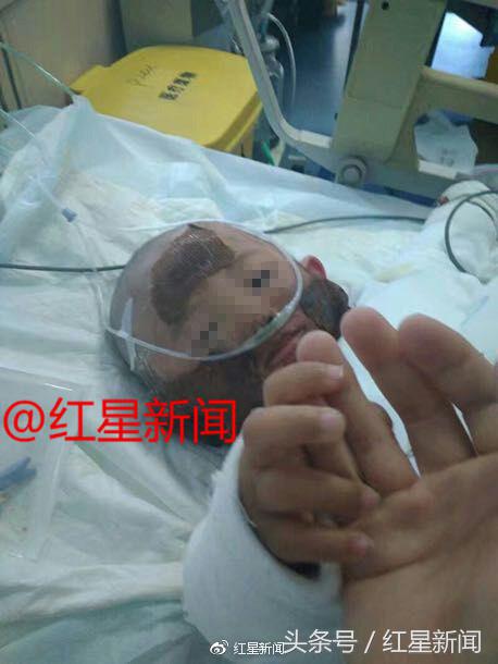 1岁女童被2000度开水烫伤后续,2岁女儿被开水烫伤完整版