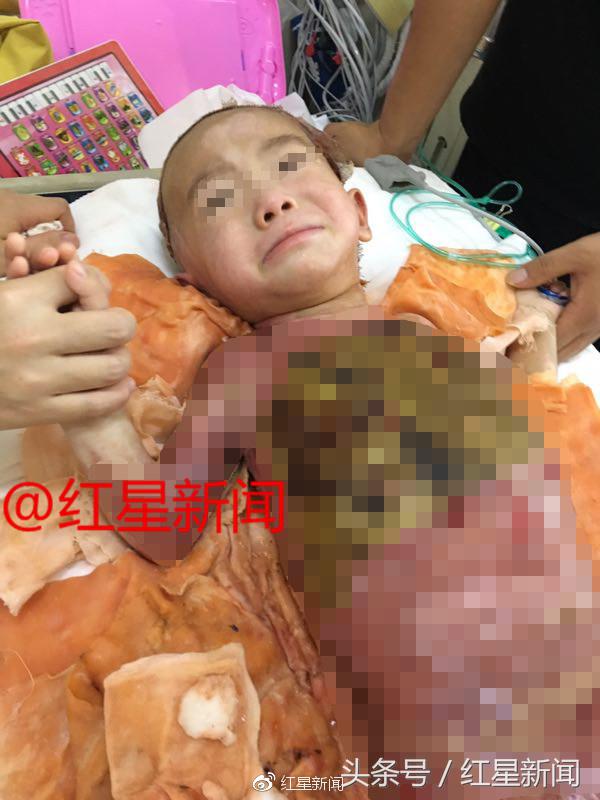 1岁女童被2000度开水烫伤后续,2岁女儿被开水烫伤完整版