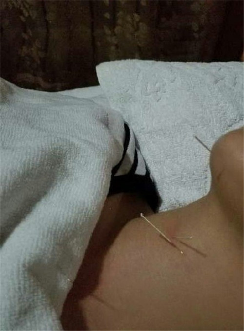 杨幂脖子前后对比,杨幂吻痕