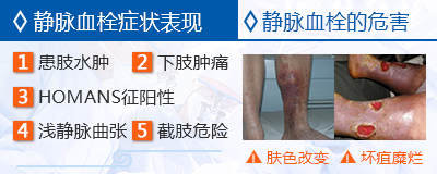 静脉血栓栓塞预防和治疗专家共识,静脉血栓防治的题目