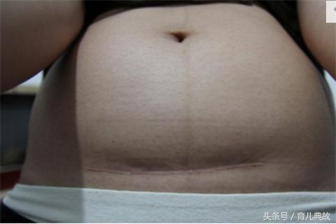 恢复得好的剖腹产疤痕,剖腹产后疤痕修复的四大误区