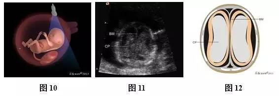 孕26周进行胎儿超声心动图检查,孕11-14周胎儿超声检测报告