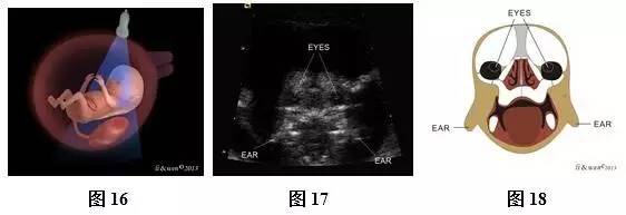 孕26周进行胎儿超声心动图检查,孕11-14周胎儿超声检测报告