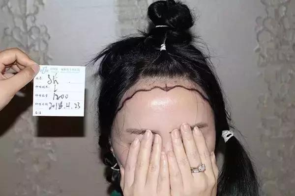 做了发际线还会长吗,做了发际线头型是不是比较好看