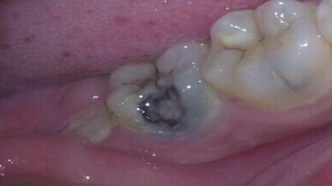 牙齿有大黑洞又痛怎么办,牙齿有黑洞很疼怎么办