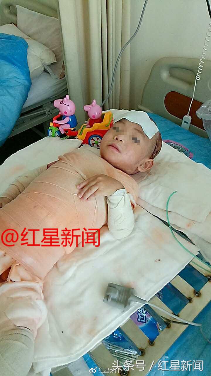 1岁女童被2000度开水烫伤后续,2岁女儿被开水烫伤完整版