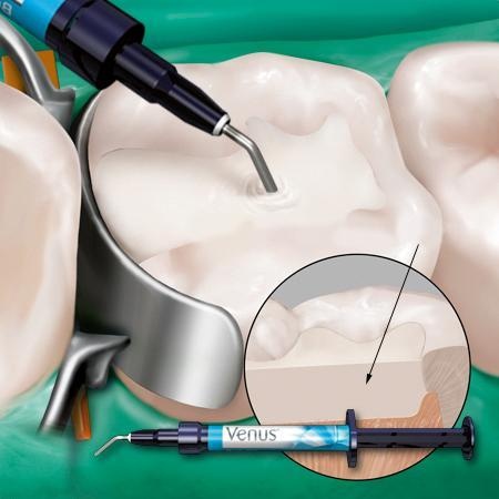 补牙告诉我们什么道理,补牙去医院怎么跟医生说