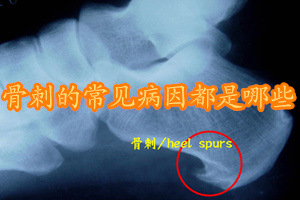 骨刺一般都是什么原因引起的,得了骨刺会有哪些症状