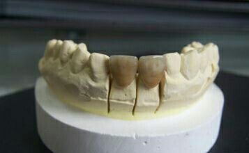 国外如何处理四环素牙,如何拯救四环素牙