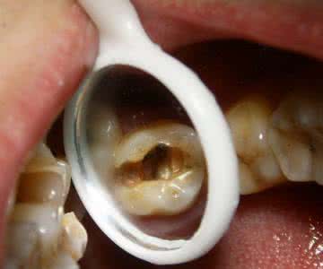 儿童蛀牙的正确治疗方法,小孩蛀牙怎么治疗最好最有效