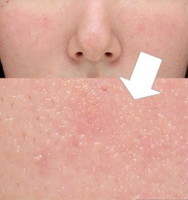 痘痘一直治不好的根本原因,痘痘是痤疮还是毛囊炎怎么判断